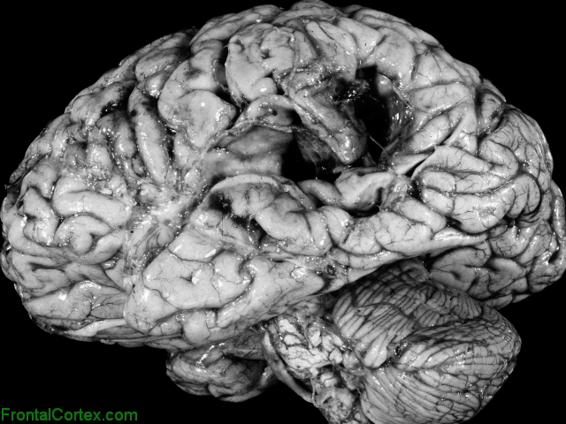 Cavitated MCA infarct, lateral surface of brain.